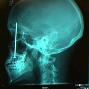 X-rays